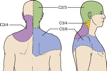 Facet Syndrome | Anesthesia Key