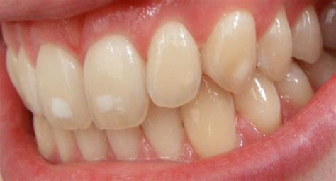 Side Effects of Fluoride in Toothpaste | Fully Explained! - Dr. Brite