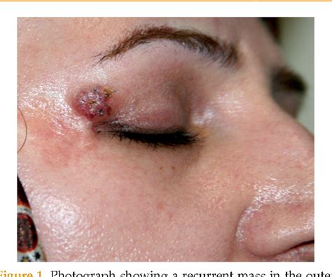 Figure 1 from Trichoblastoma of the Upper Eyelid | Semantic Scholar