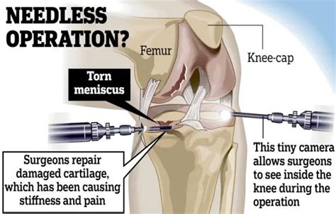 Knee cartilage repair surgery: recovery time & aftercare