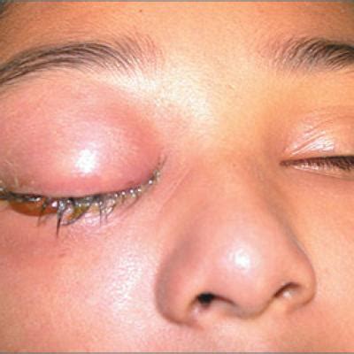 Severely swollen eye | MDedge Family Medicine
