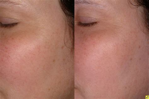 Facial Redness Treatment minneapolis | Zel Skin