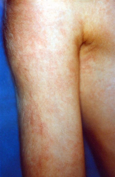 Mottled skin or Cutis Marmorata in neonates - Doctors Gates