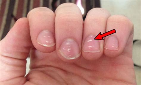 What Causes Dark Spots On Fingernails - Design Talk