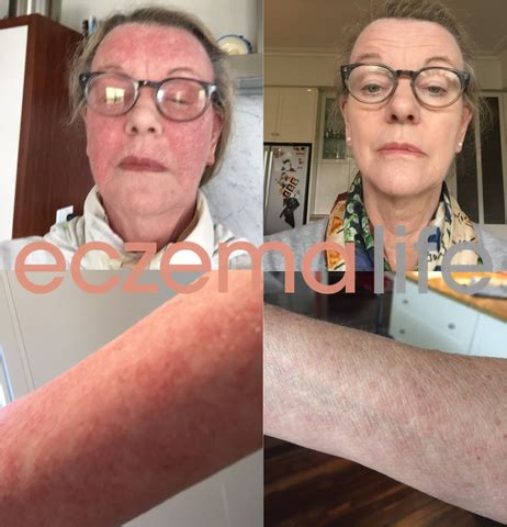 Eczema Diet Before and After Photos – Eczema Life