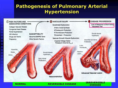 PPT - Pulmonary Hypertension PowerPoint Presentation, free download ...