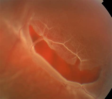 Retinal Tear at the Posterior Edge of Lattice Degeneration - Retina Image Bank