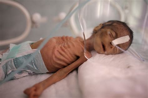 Yemen conflict escalates as country speeds toward famine | Hot Springs ...