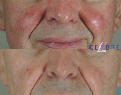 Rosacea Treatment Before and After Pictures