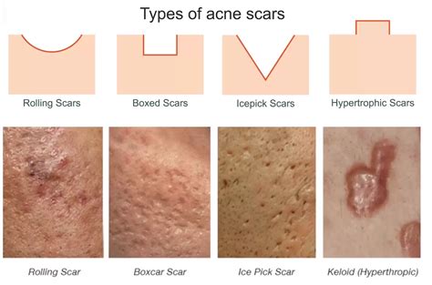 Unmasking Your Skin's True Potential: Conquering Acne Scarring Like a ...