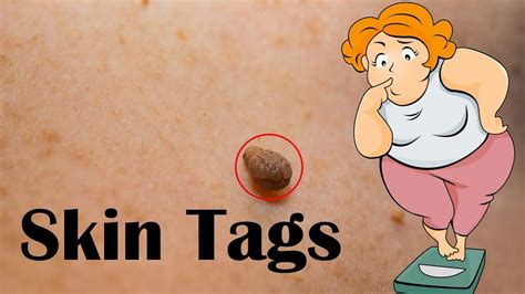 Skin Tags (Acrochordon) - Causes, Signs & Symptoms, And Treatment
