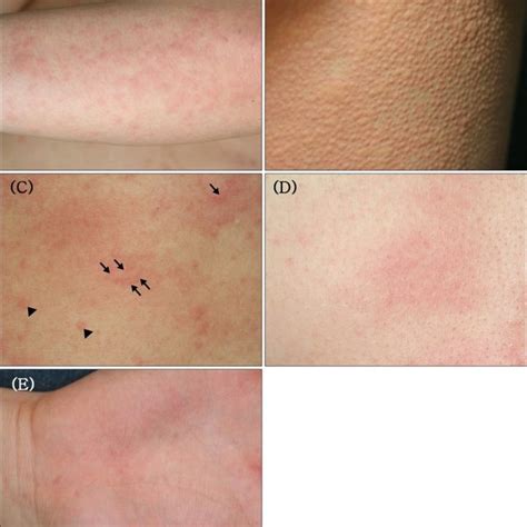 Cholinergic Urticaria