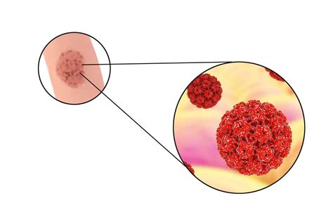 HPV Symptoms, Treatment, Vaccine, HPV in Men and Women