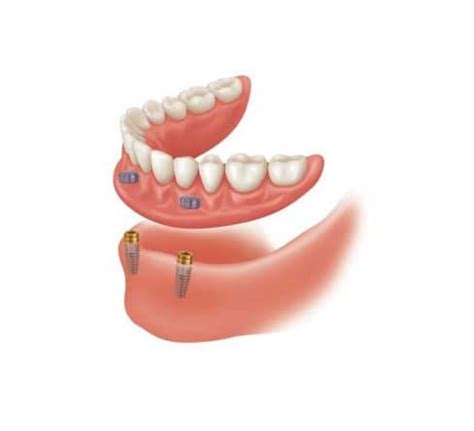 Snap-in dentures | Dental Implants at the cost of Dentures