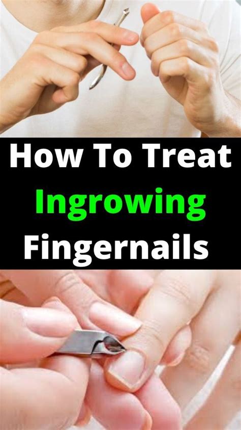 How To Treat An Ingrown Fingernail | Ingrown fingernail, Fingernails, Nail care tips