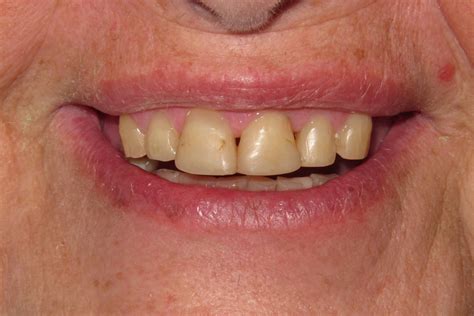 Removable Partial Dentures Smile Gallery - Raber Dental, Kidron Dentist