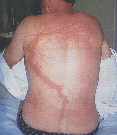 Lichtenberg Figures: The Fractal Patterns of Lightning Strike Scars » TwistedSifter