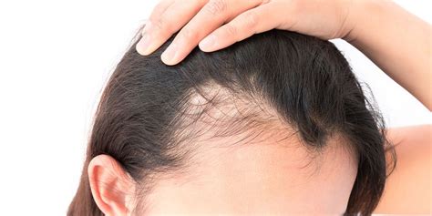 Androgenetic Alopecia Treatment, Cost in Mumbai, India – QR678