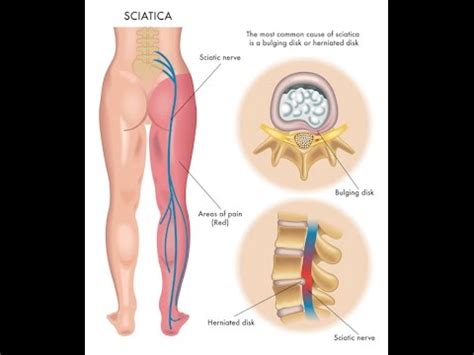 What is Sciatica? - YouTube