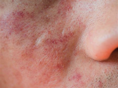 An Overview of Eczema on the Face (2022)