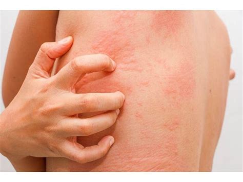 Eczema, psoriasis, and hidradenitis suppurativa linked to chronic ...