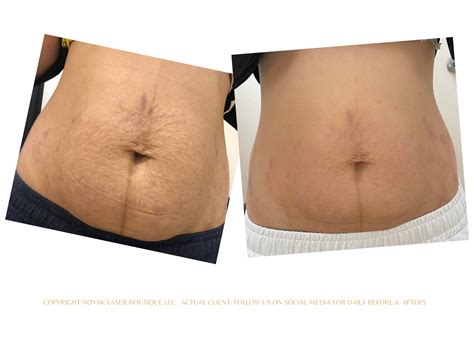 Laser Stretch Mark removal | Stretch Mark Treatment | Las Vegas Stretch Marks Removal — Novak ...