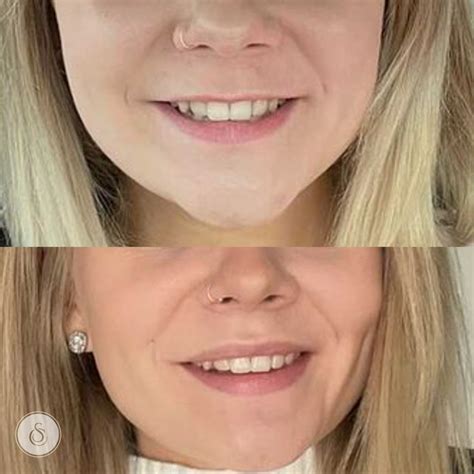 BTX Lip Flip for a radiant smile | Sarasin Clinic