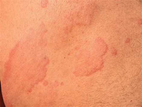 Can Dog Hives Be Caused By Stress