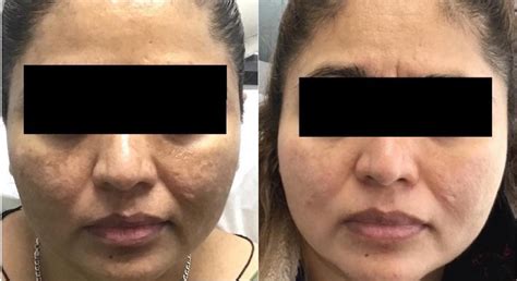 Topical Treatment for Melasma Before & After Photos Patient 43 | Houston, TX | DermSurgery ...