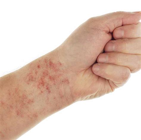 Causes Of Rash Purple