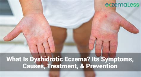 What Is Dyshidrotic Eczema? Its Symptoms, Causes, Treatment, & Prevention | Eczemaless