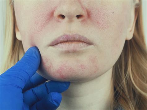 Redness / Rosacea - VivaSkin Dermatology