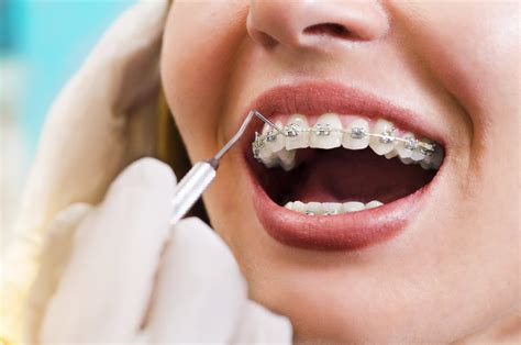 Perfect Smiles: 7 Simple Advantages of Metal Braces