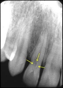 Dens Invaginatus – Dr. G's Toothpix