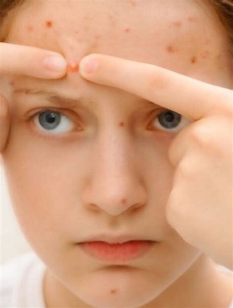 How To Treat Cystic Pimple On Forehead? Causes And Prevention ...