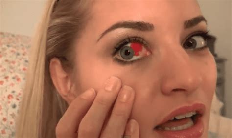 Burst Blood Vessel in Eye: Symptoms, Causes, Treatment - YouMeMindBody