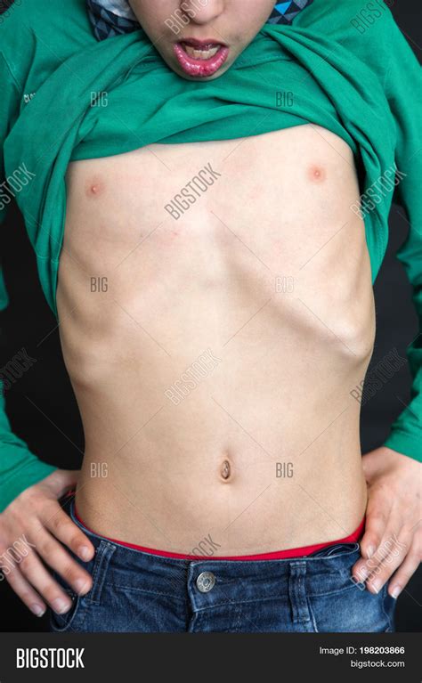 Underweight Child - Image & Photo (Free Trial) | Bigstock