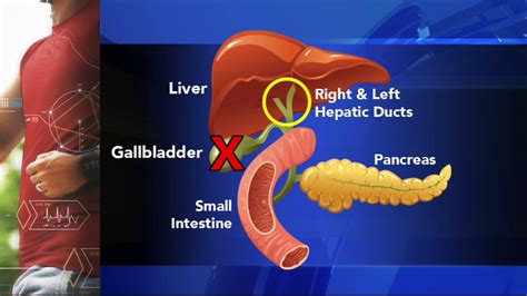 What are Gallstones? Gallbladder attack symptoms, diagnosis and treatment and surgery options ...
