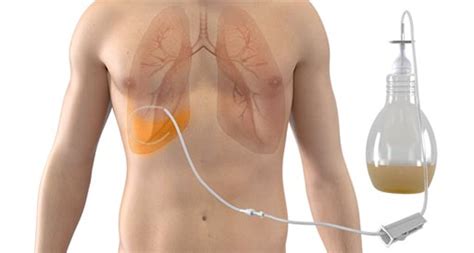 Catheter System Drains Recurrent Pleural Effusions – Critical Care News | News for Critical Care ...