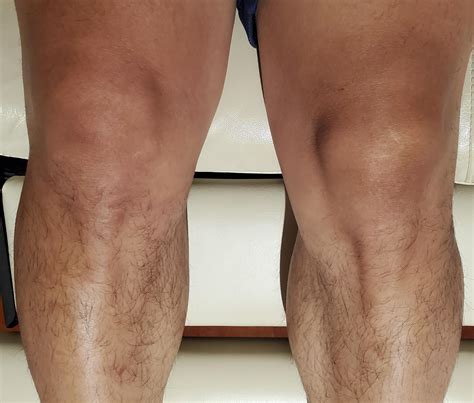 Do I have swelling in my right knee? (Pictured is flipped) : r/KneeInjuries