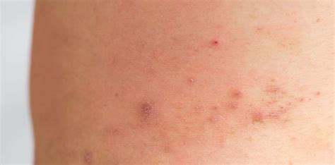 Ichthyosis Vulgaris Causes Clear Skin Clinic