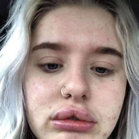 9+ Lip Implants Before And After Pictures - TanishqFeyza