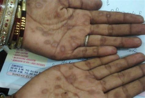 Hiv Rash On Hands