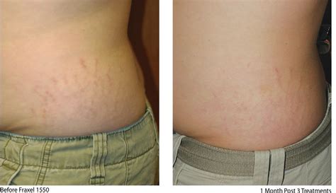 Stretch marks before and after laser