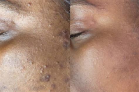 AnteAGE MD Microneedling - Accelerated Aesthetics