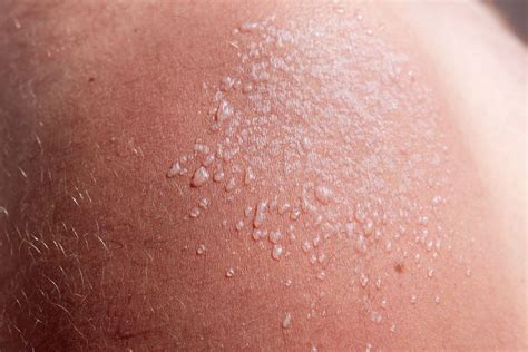 Sun Blister: Here's How to Tell If You Have One, and How to Treat It | The Healthy