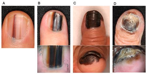 Representative images of nail apparatus melanoma and dermoscopy (lower ...