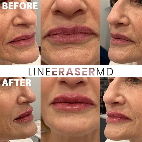 Botox Treatment In NJ: Before & After Gallery | Line Eraser MD