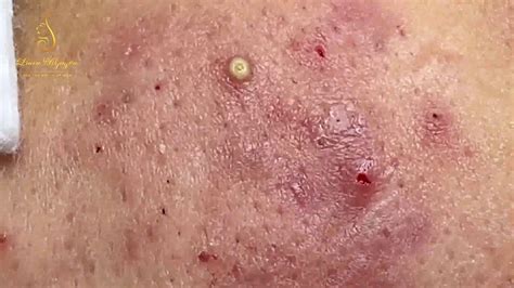 Treatment of pustules and inflammatory acne (84) | Loan Nguyen