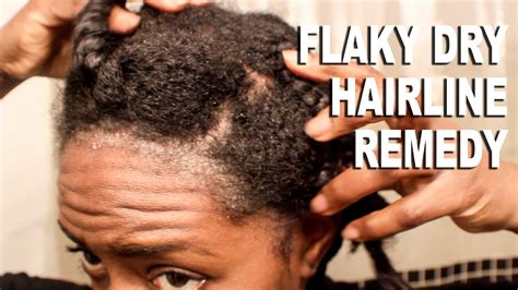 Natural Hair| Flaky & Dry Hairline Scalp Remedy|SCALP PSORIASIS ...